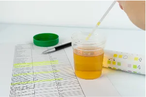Urine sample with a test strip and medical report, emphasizing health diagnostics, urinalysis testing, preventive healthcare, and routine medical monitoring.